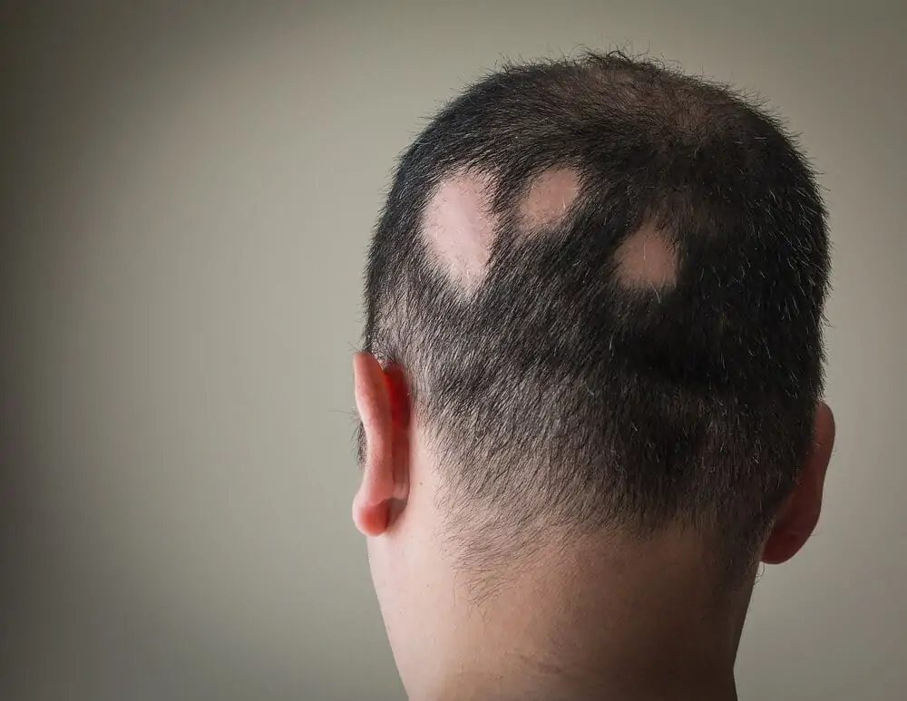 Alopesi nedir