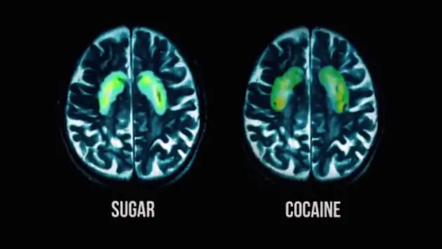 Fed up sugar cocaine brain scan 620